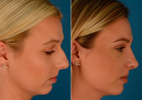 Wow, amazing results. . Bumped my nose after rhinoplasty reddit